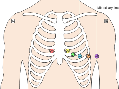 ECG electrode placements
